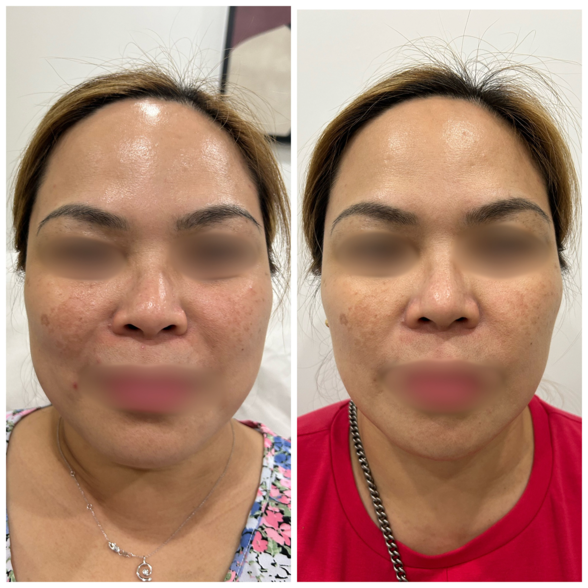 “Jawtox” or Botulinum Toxin Injections for Masseter