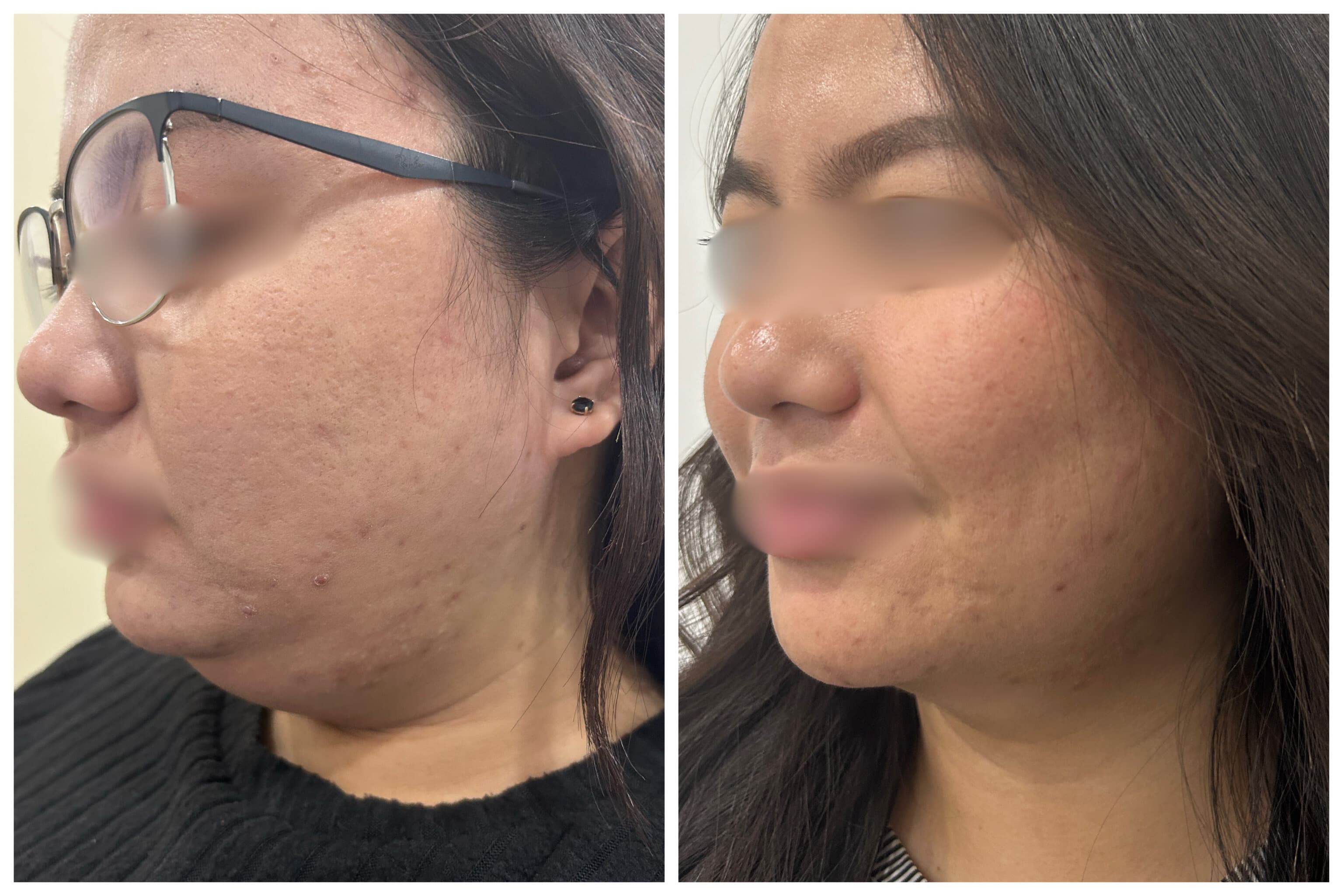 Lipodissolve of Double Chin