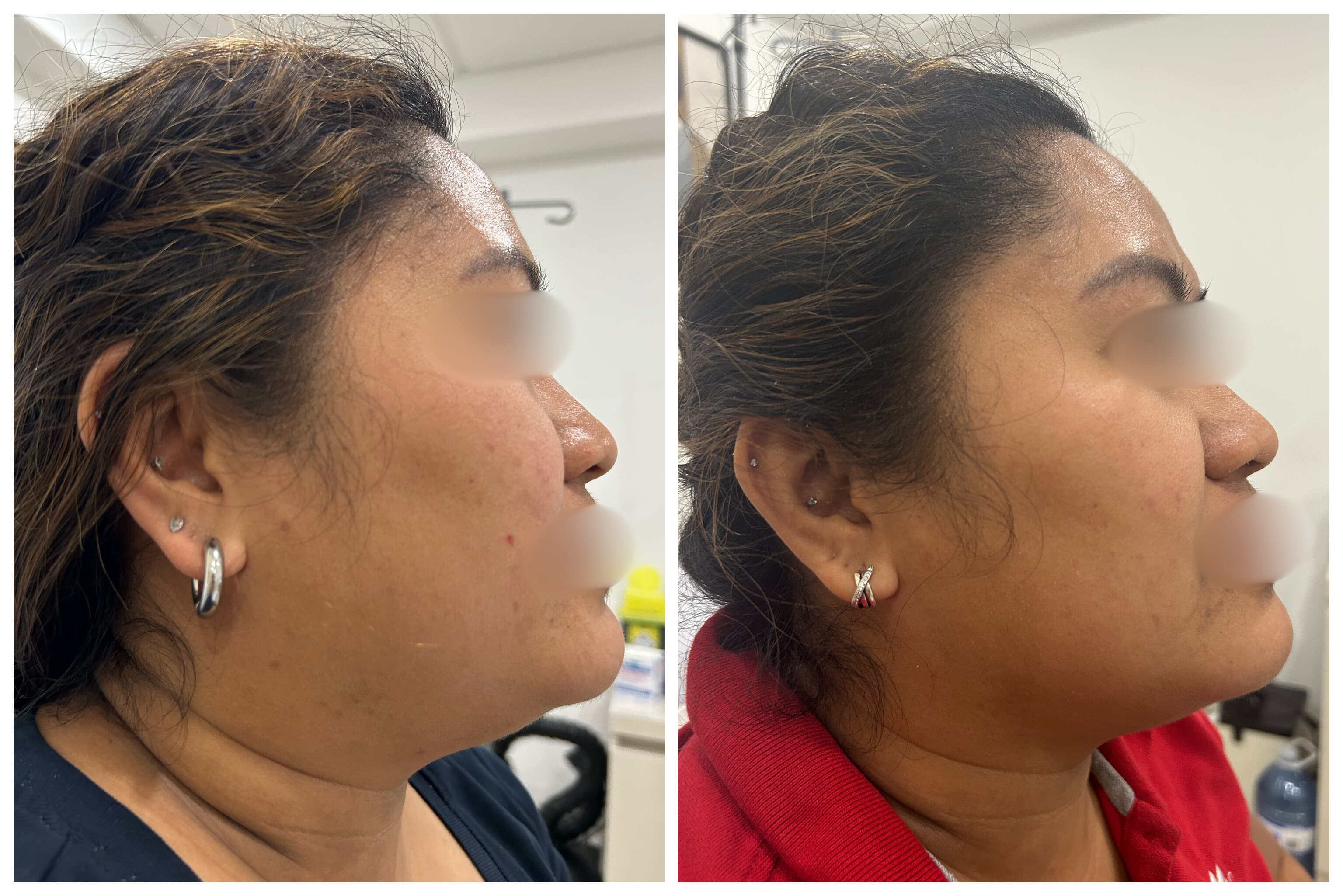Lipodissolve of Double Chin and “Jawtox”