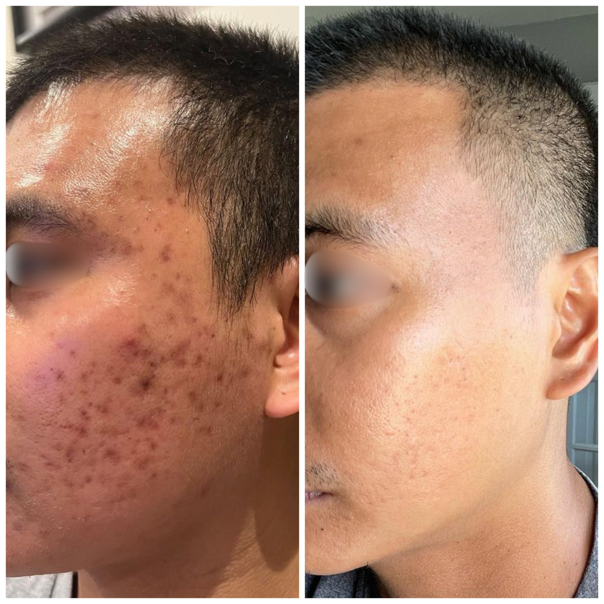 Microneedling