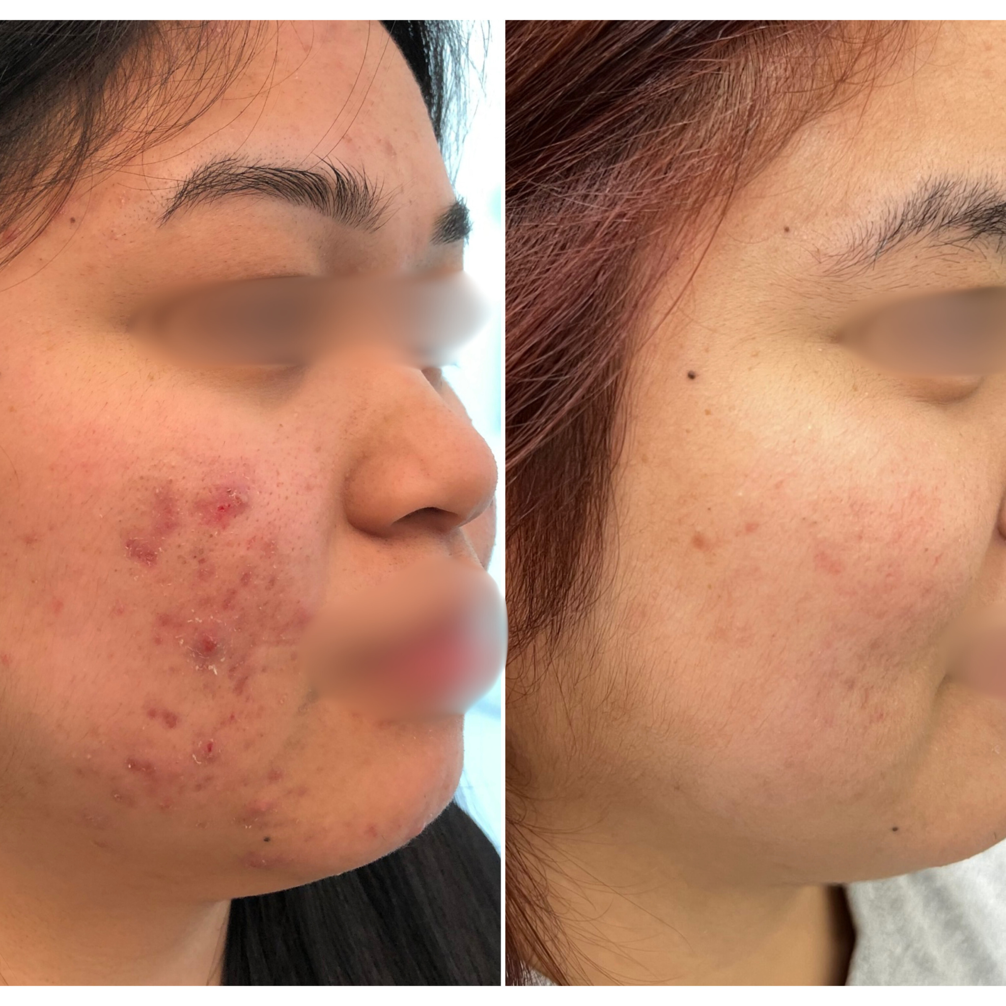 Acne Treatment and Microneedling Protocol