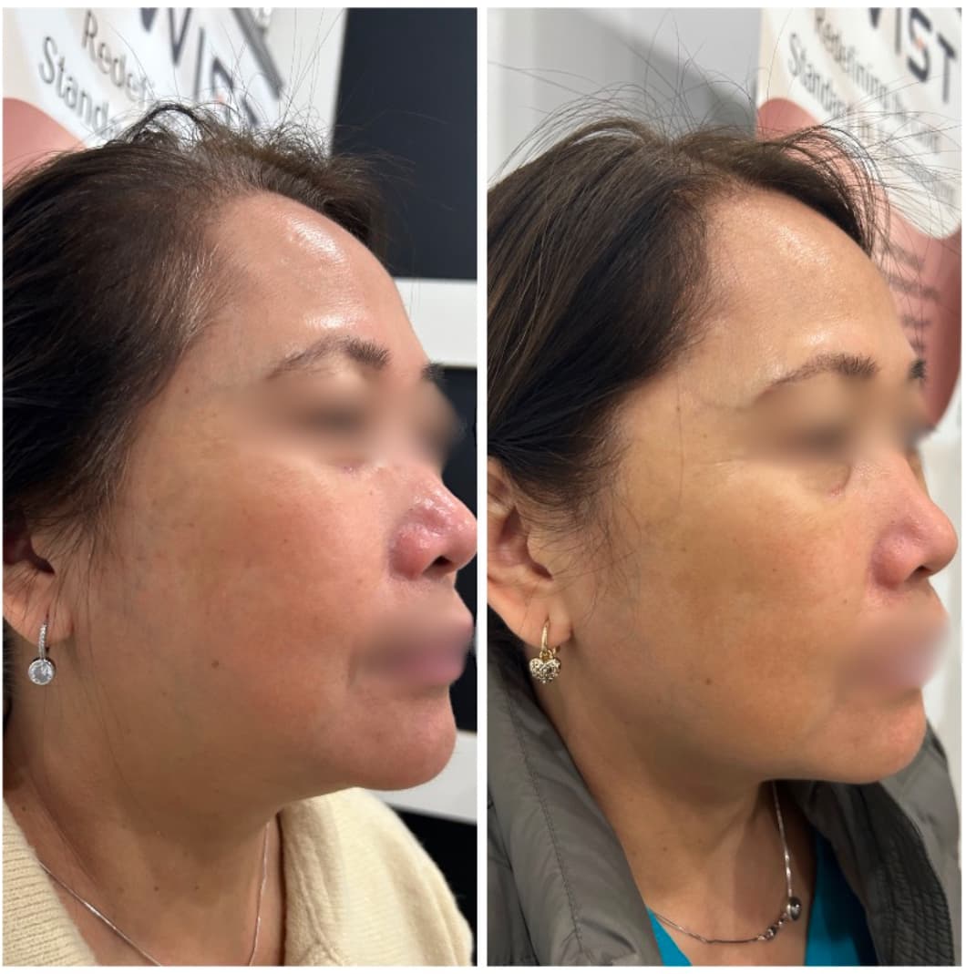 TriPollar® Skin Tightening Treatment