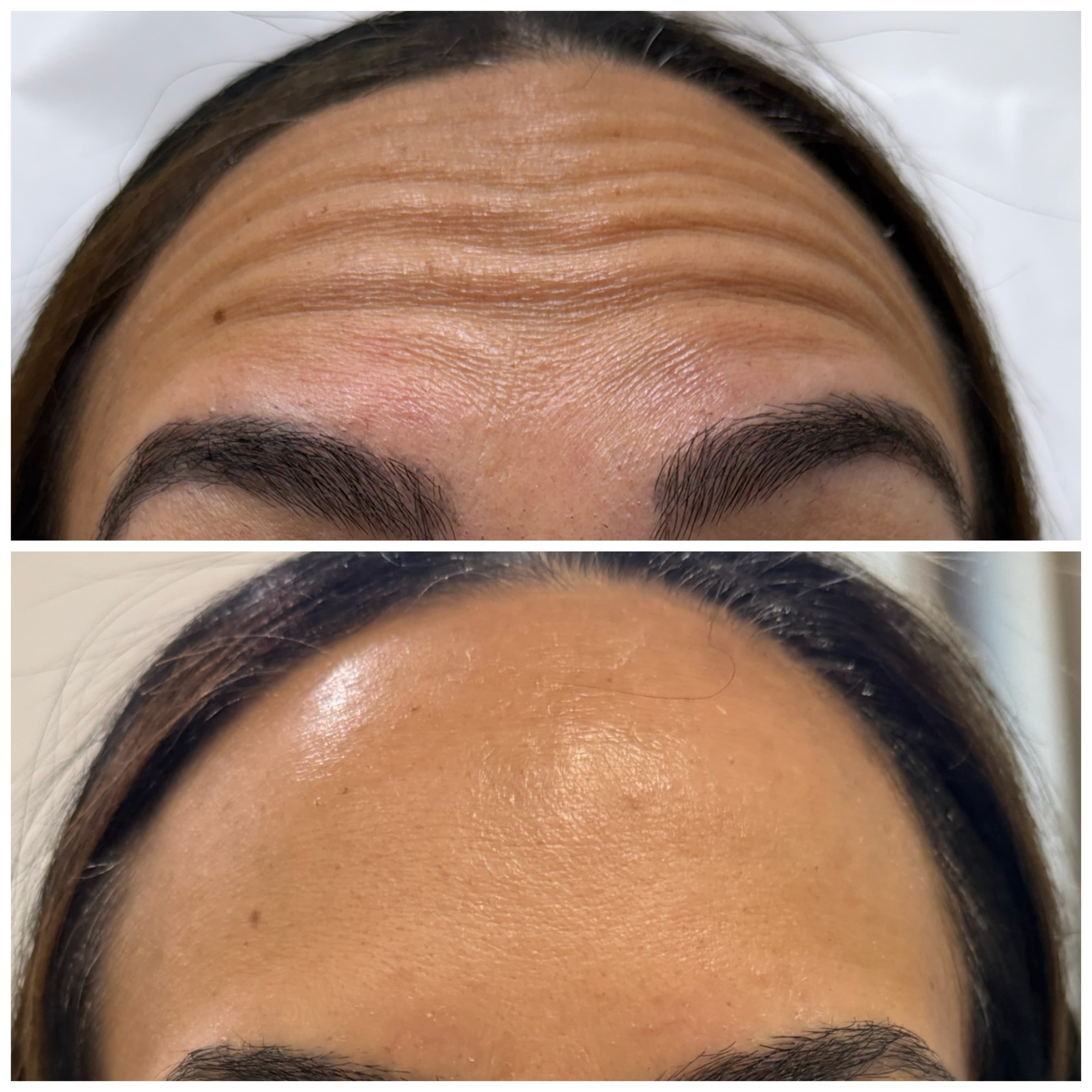 Botulinum Toxin Injections for Upper Face