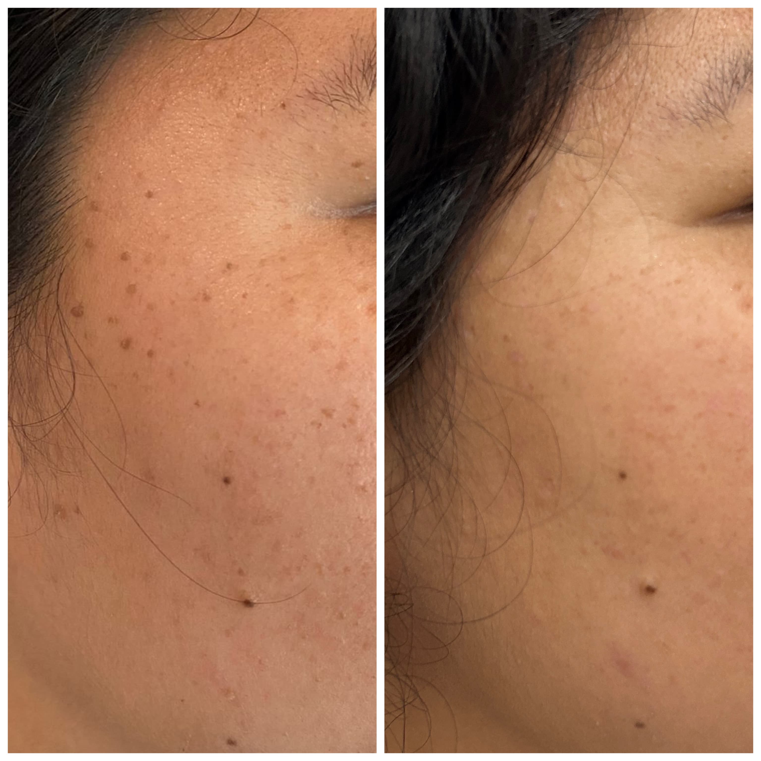 Benign Lesion Removal