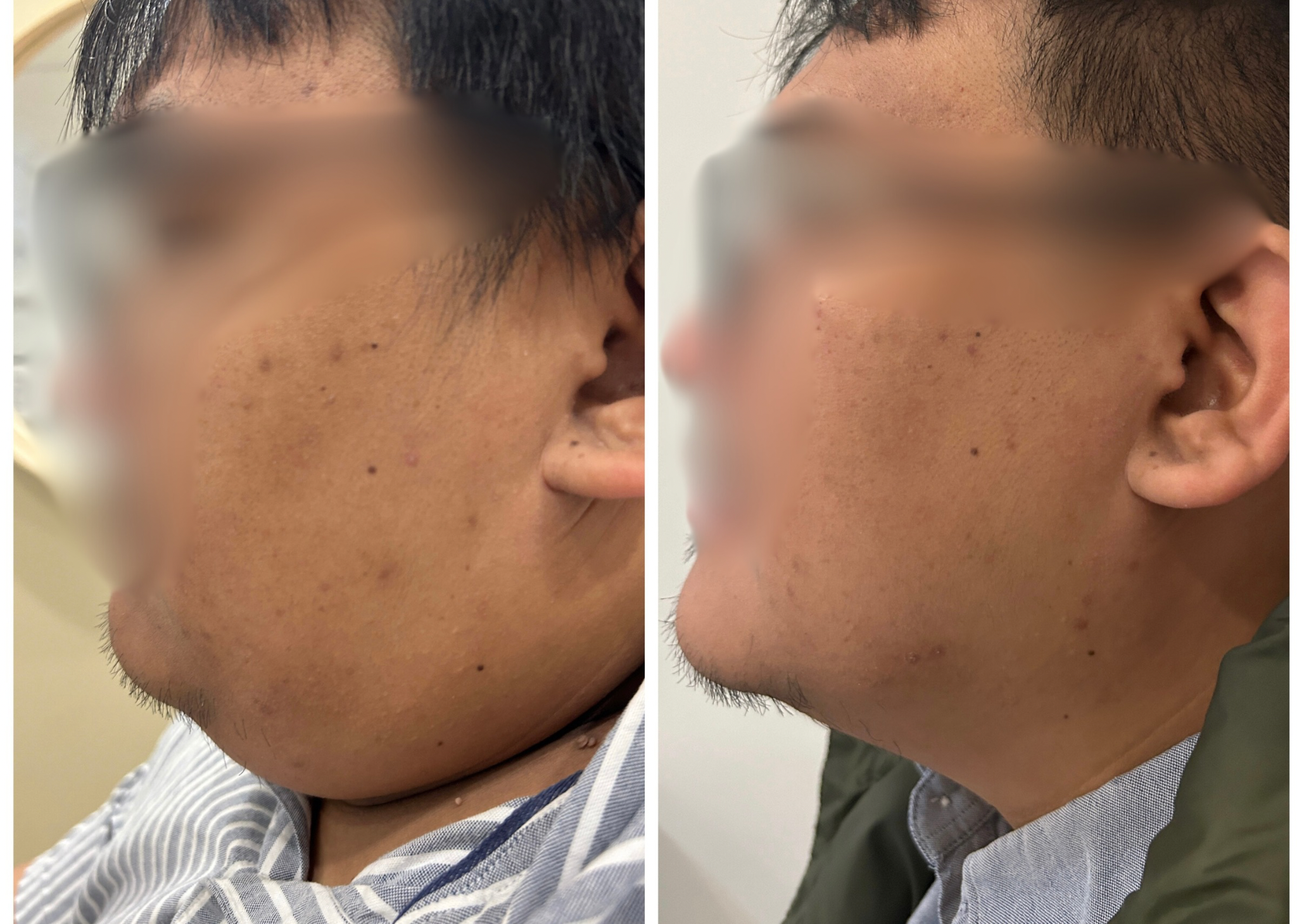 Lipodissolve of Double Chin