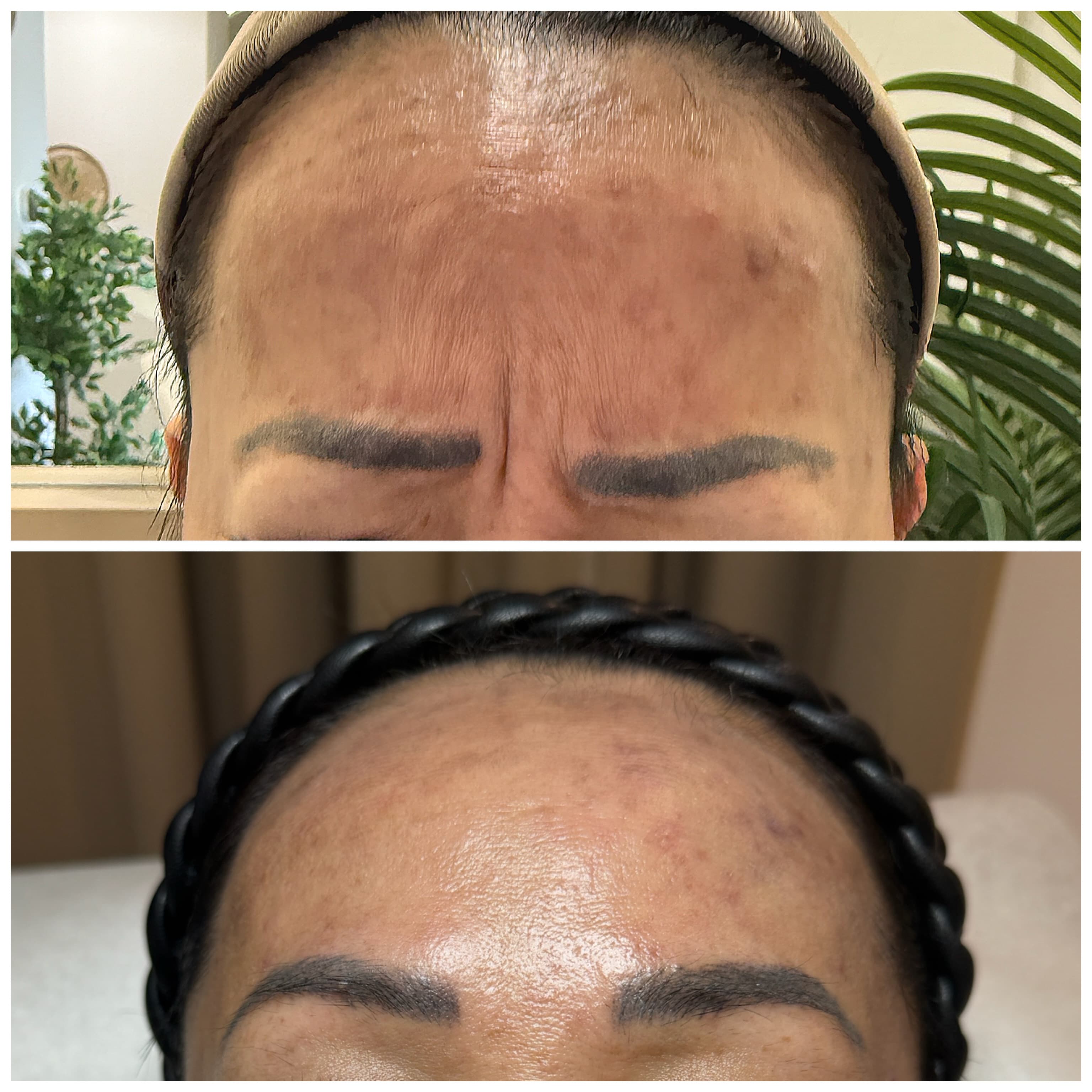 Botulinum Toxin for Glabellar Lines