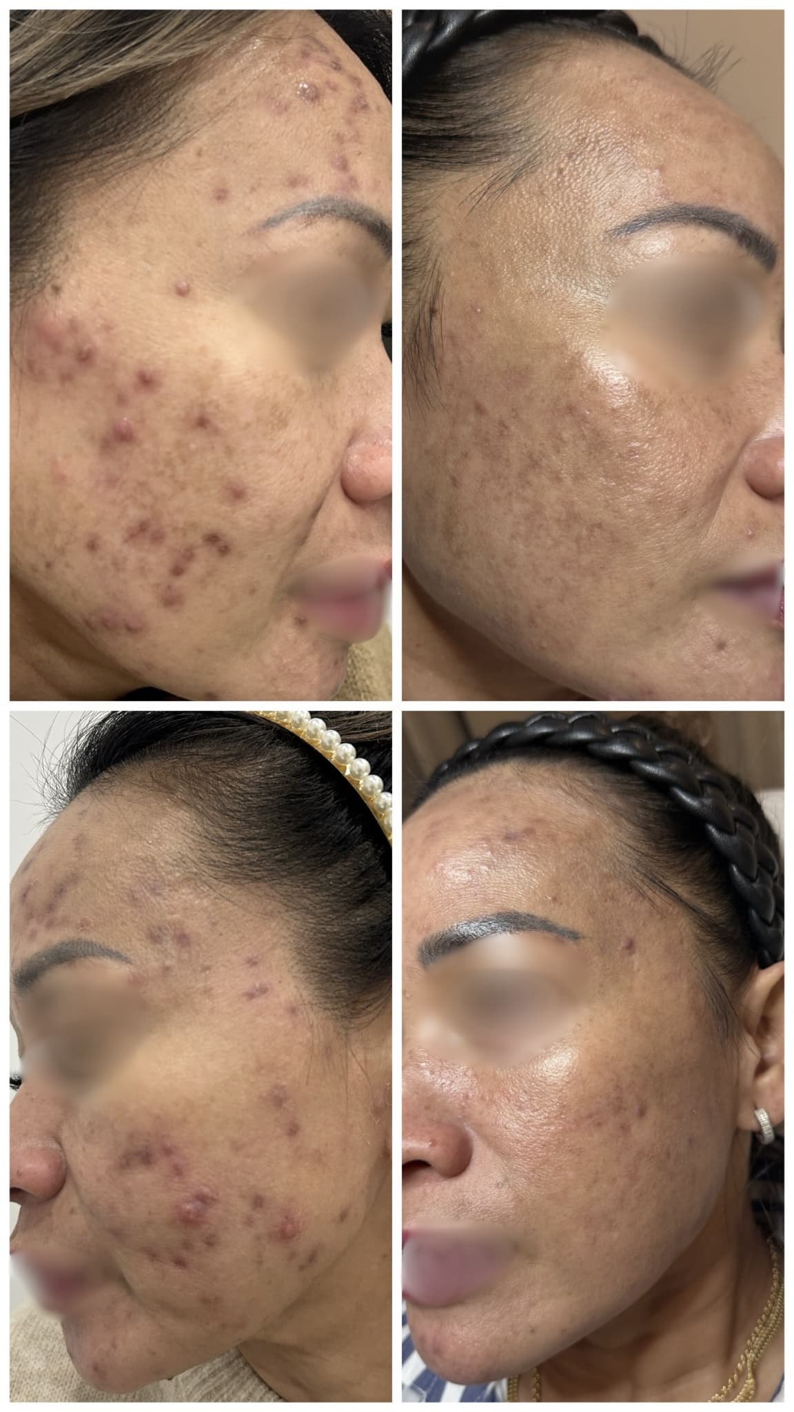 Acne Treatment and Microneedling Protocol