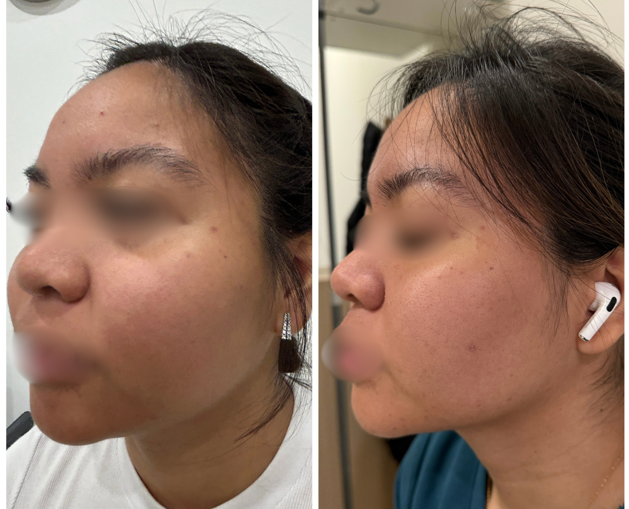 TriPollar® Skin Tightening Treatment